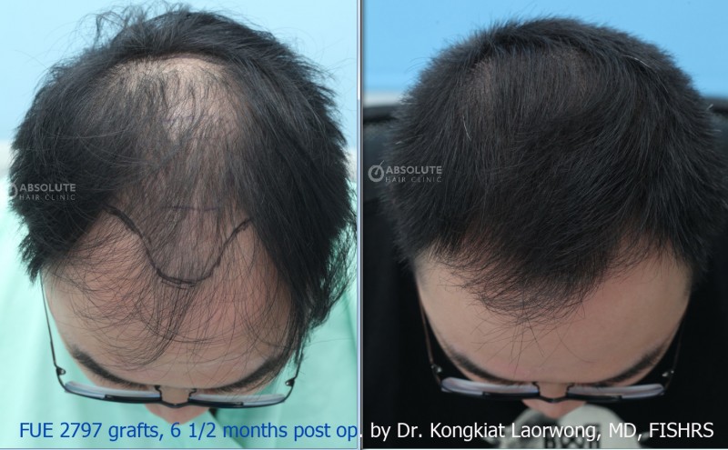 case 7 FUE 2797 grafts,  months, FUE hair transplant Thailand