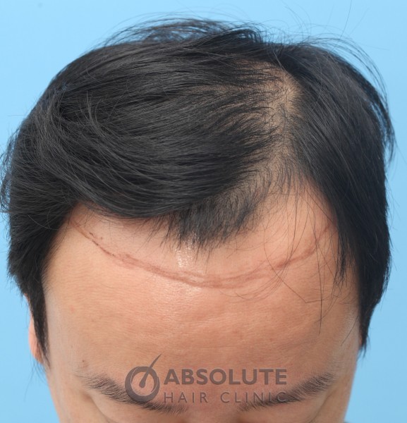 case 14, 3500 grafts in 2 sessions, 1 year after second session, FUE hair  transplant Thailand