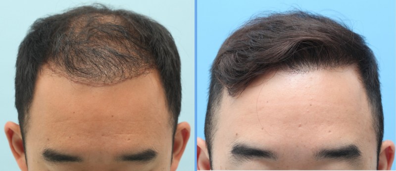 case 5 FUE 3060 grafts, 17 months result, FUE hair transplant Thailand
