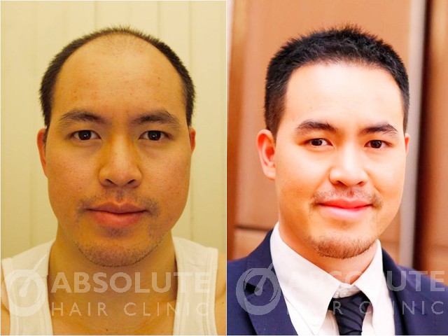 FUE hair transplant Thailand, FUE hair transplantation Bangkok Thailand  ปลูกผมFUE หมอก้องเกียรติ ปลูกผมเองทุกเคส