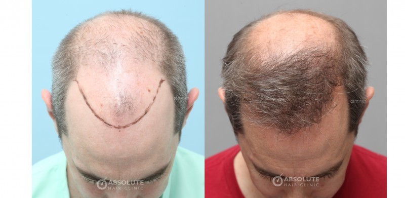 case 67 ปลูกผม FUE 3200 grafts, 1 year result FUE hair transplant Thailand