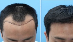 case 4 FUE 1989 grafts, 8 months result, FUE hair transplant Thailand