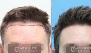 Case 9 FUE 1250 grafts,  months result, FUE hair transplant Thailand